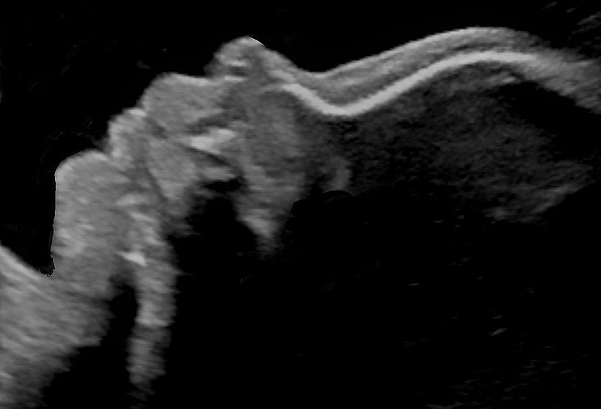 Echographie 1er trimestre Image